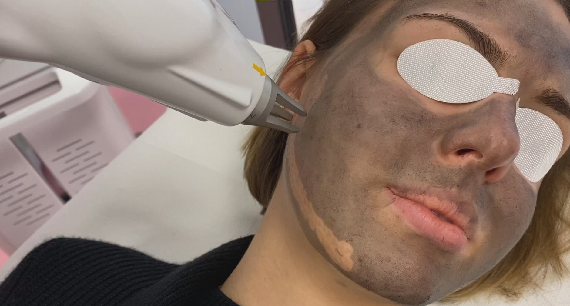 Laserowy Peeling W Glowy Wroc Aw Stop Time Med Clinic